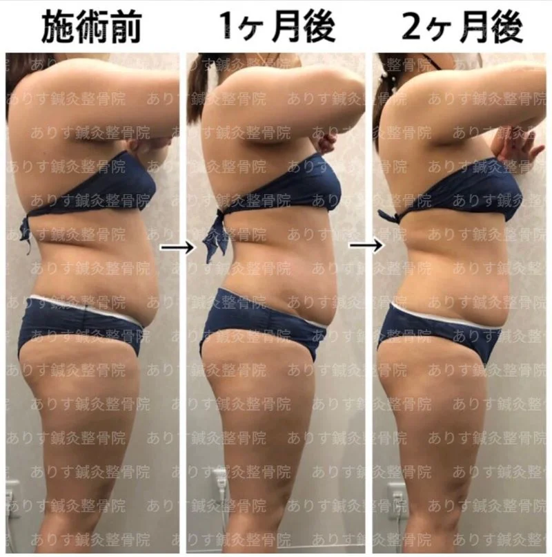 脂肪冷却2ヵ月後のお客様!!ダイエットなら高松市ビューティーアリスに